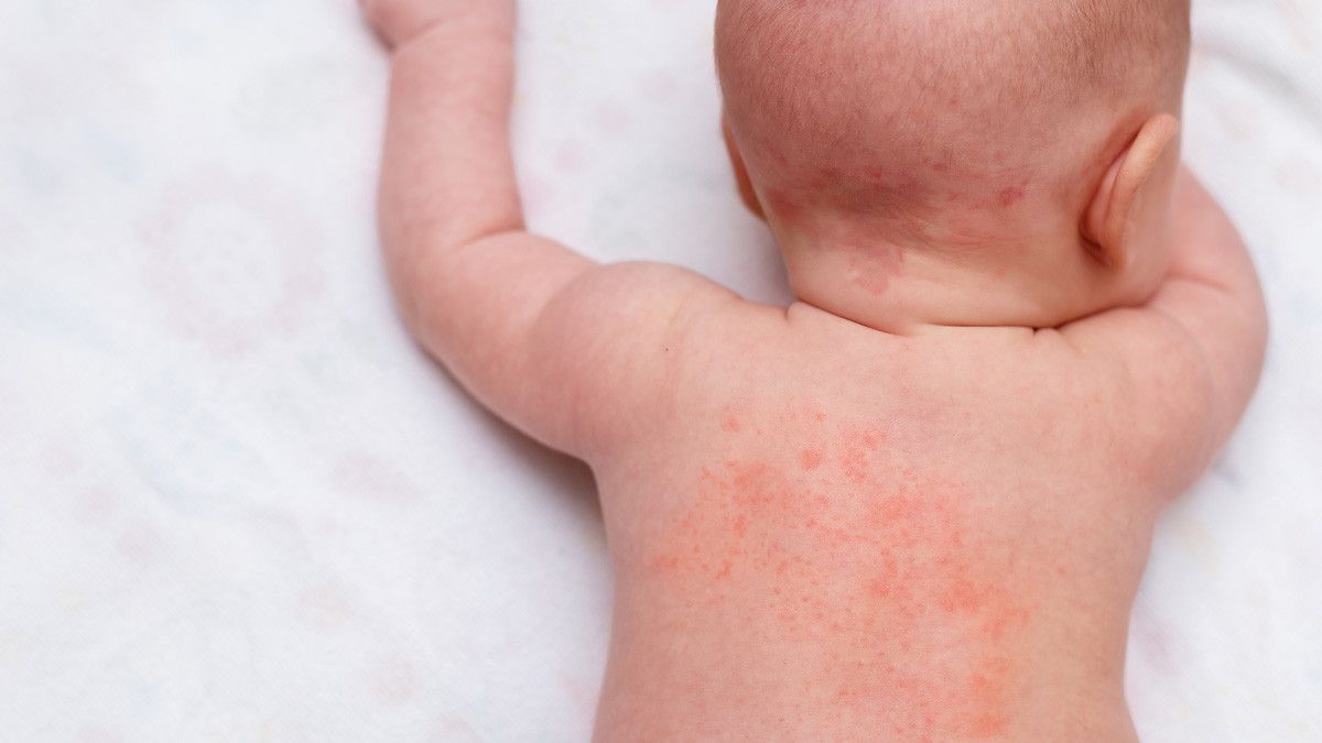 4 Masalah Kulit yang Rentan Terjadi pada Bayi