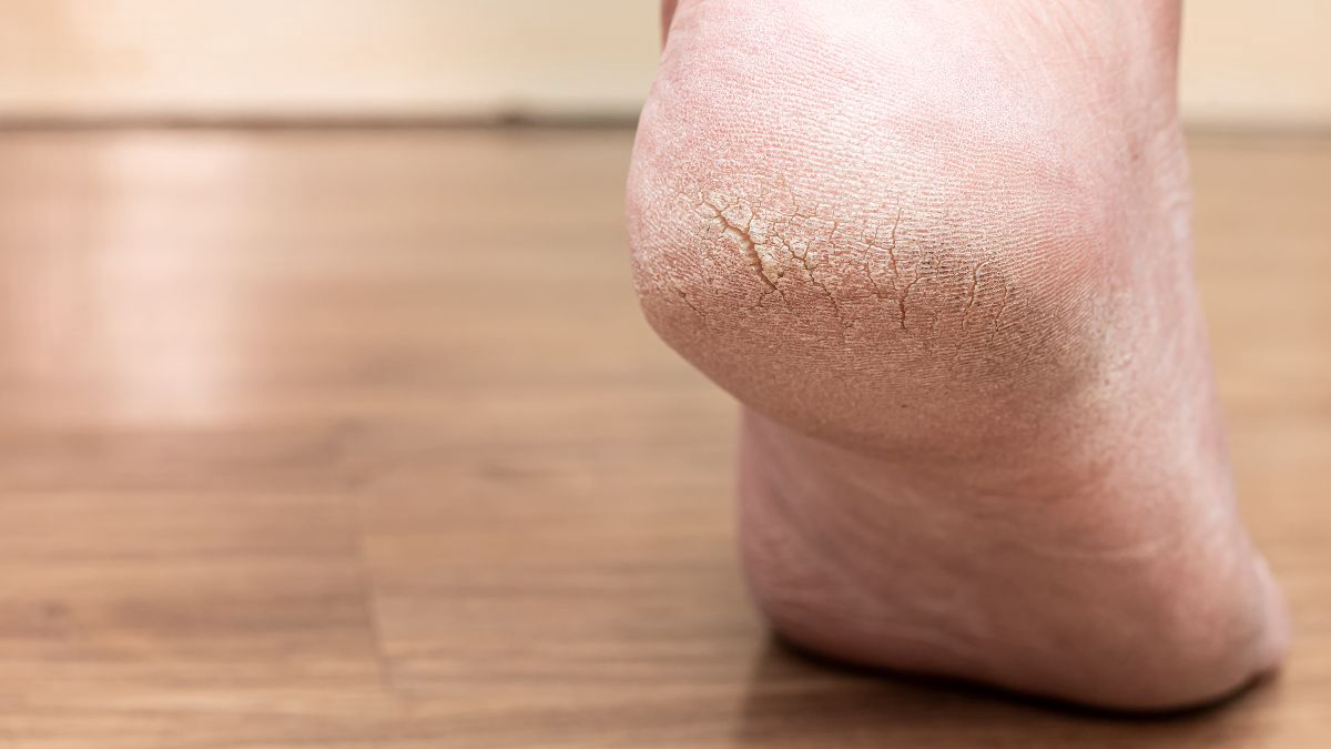 ilustrasi tumit pecah