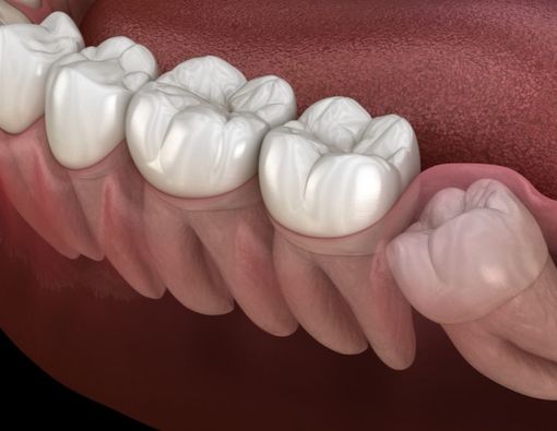 8 Bahaya Jika Gigi Bungsu yang Tumbuh Miring Tidak Dicabut