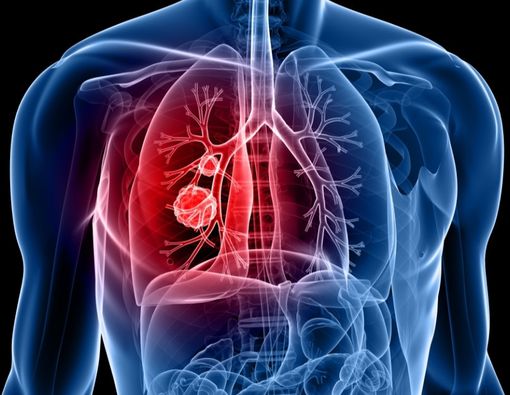Penyebab dan Gejala Kanker Paru Non Sel Kecil