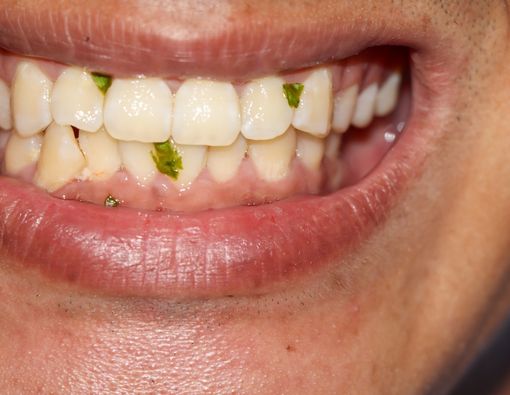 6 Bahaya Membiarkan Makanan Nyangkut di Gigi