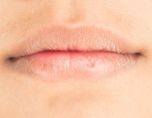 Penyebab Bibir Terasa Kebas dan Kesemutan