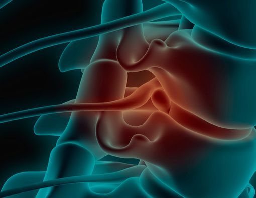 Mengalami Saraf Kejepit, Bisakah Disembuhkan?