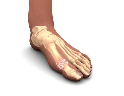 Mengenal Gejala Asam Urat Berdasar Tingkat Keparahan