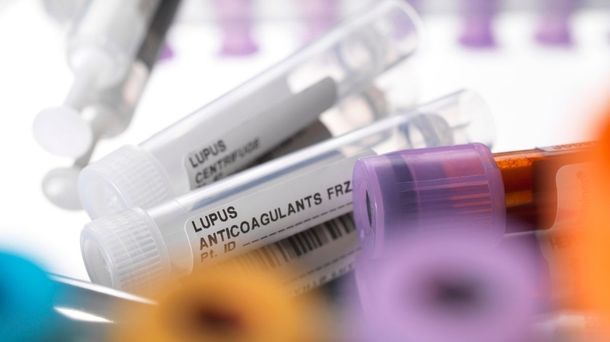 Beragam Cara Efektif Mencegah Lupus Kembali Kambuh