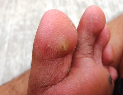 Kenali Penyebab Timbulnya Penyakit Kulit Mata Ikan