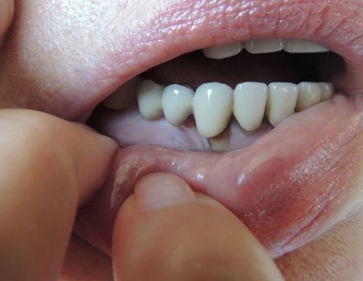 Apakah Periodontitis Bisa Menular Melalui Ciuman?