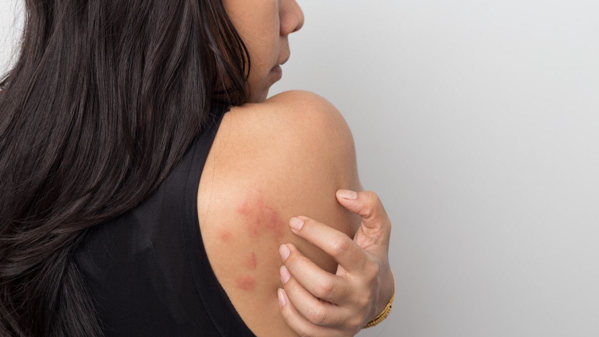 Mengapa Biduran Tak Boleh Digaruk?