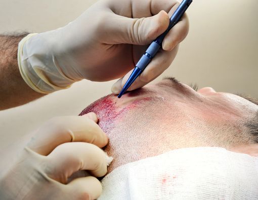 Implan Rambut, Cara Efektif Atasi Kebotakan pada Pria