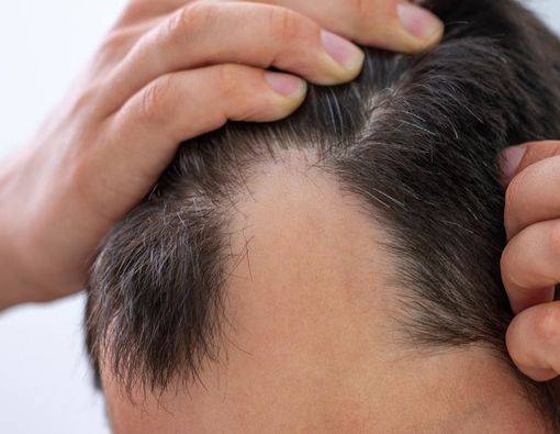 6 Gangguan Kesehatan yang dapat Dideteksi dari Rambut Anda