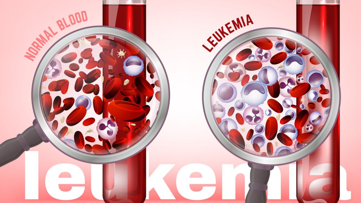 9 Gejala Leukemia yang Tak Boleh Diabaikan