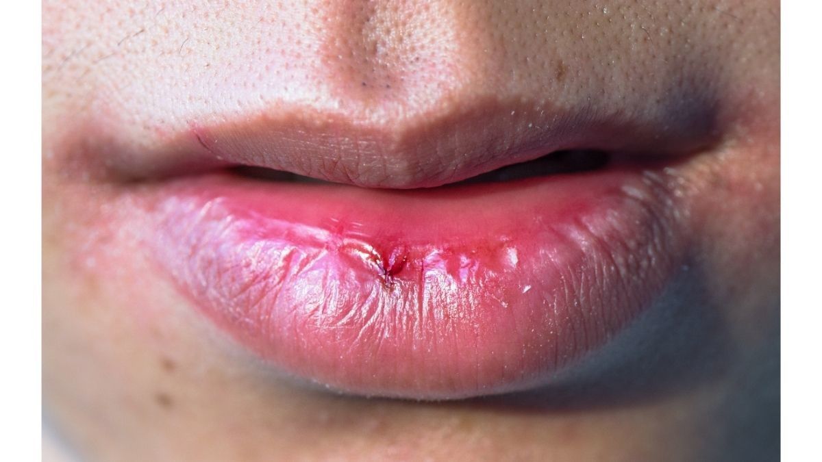 Tanda dan Gejala Kanker Bibir yang Mesti Anda Waspadai
