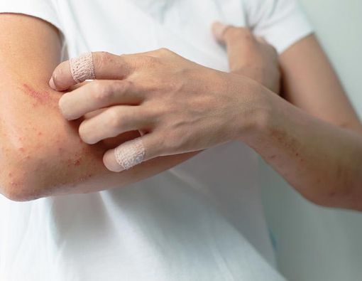 Beruntusan Bukan Melulu Akibat Biang Keringat