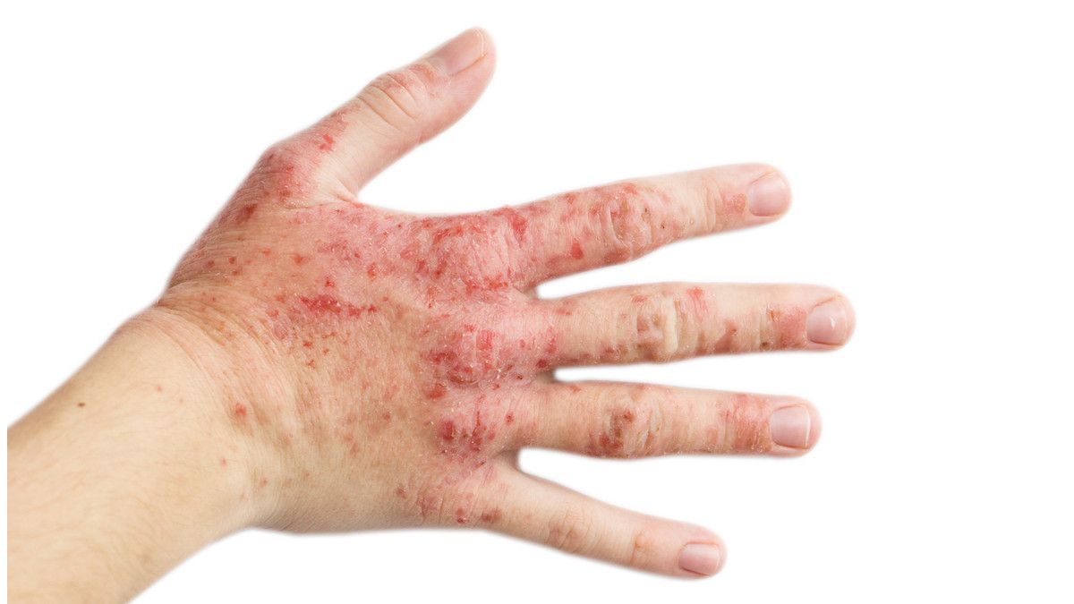 Ruam Akibat Corona Bisa Bertahan Lama