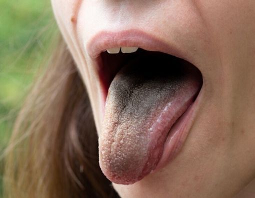 Bukan Karena Permen Warna, Ini Penyebab Lidah Jadi Hijau