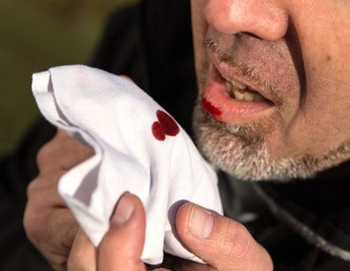 Jangan Anggap Remeh Batuk Berdarah!