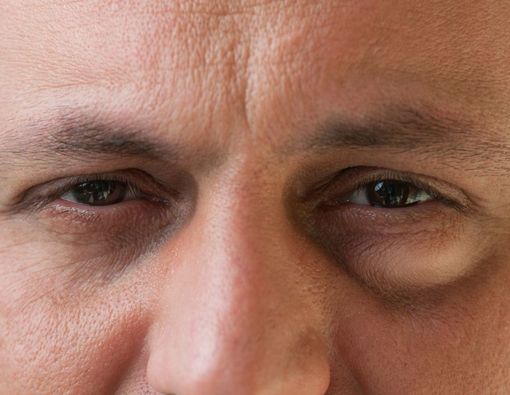 Berbagai Kondisi yang Menyebabkan Kelopak Mata Bengkak