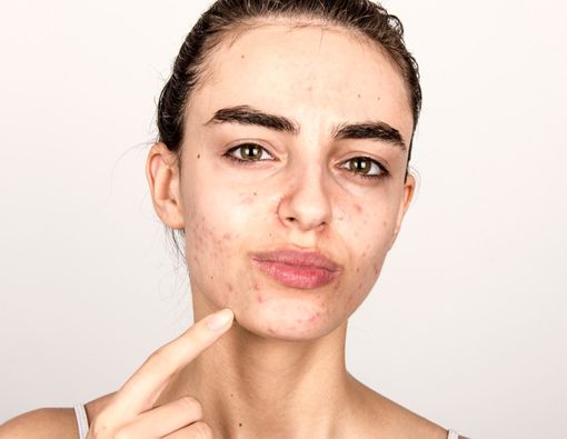 Makanan Manis Bikin Jerawat Muncul?