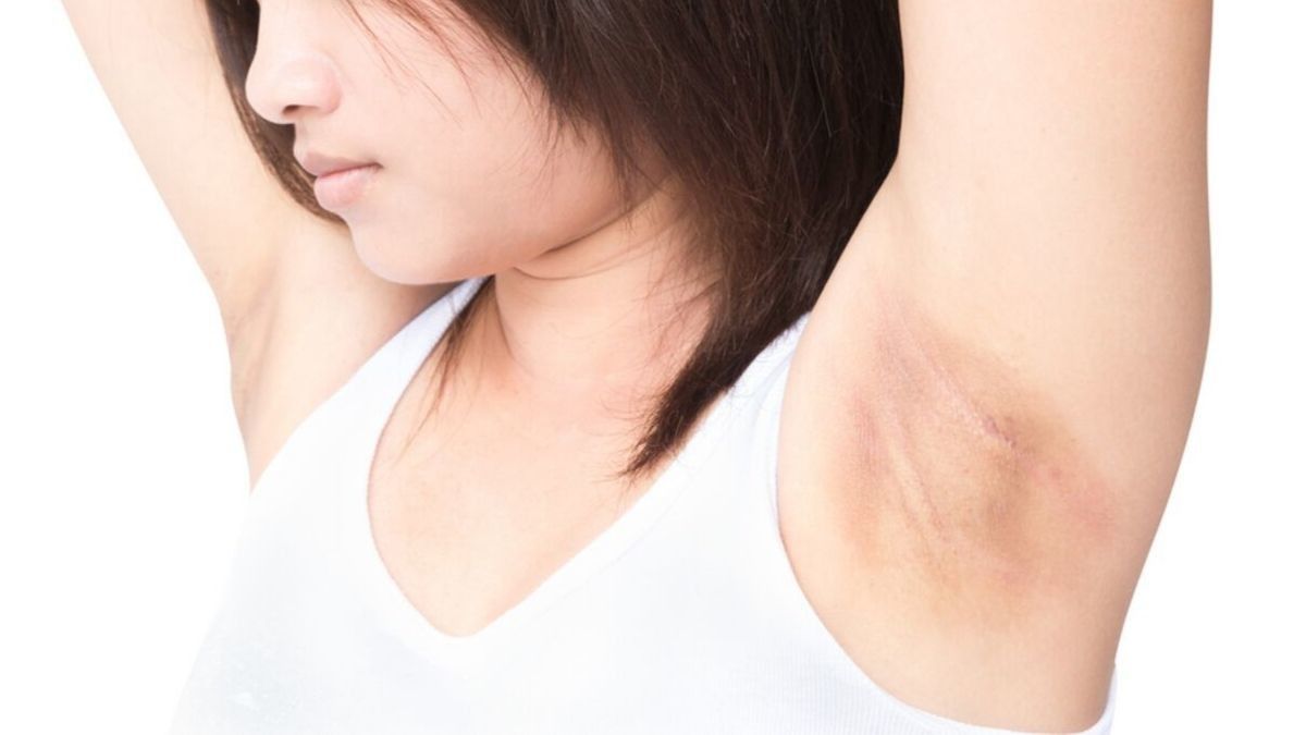 Ketiak Hitam Akibat Deodoran, Ini Cara Memutihkannya