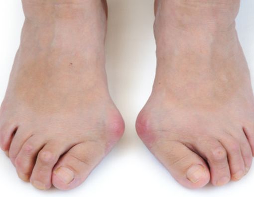 Menghilangkan Bunion Tanpa Operasi