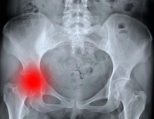 Patah Tulang Panggul, Penyebab dan Cara Mengatasinya