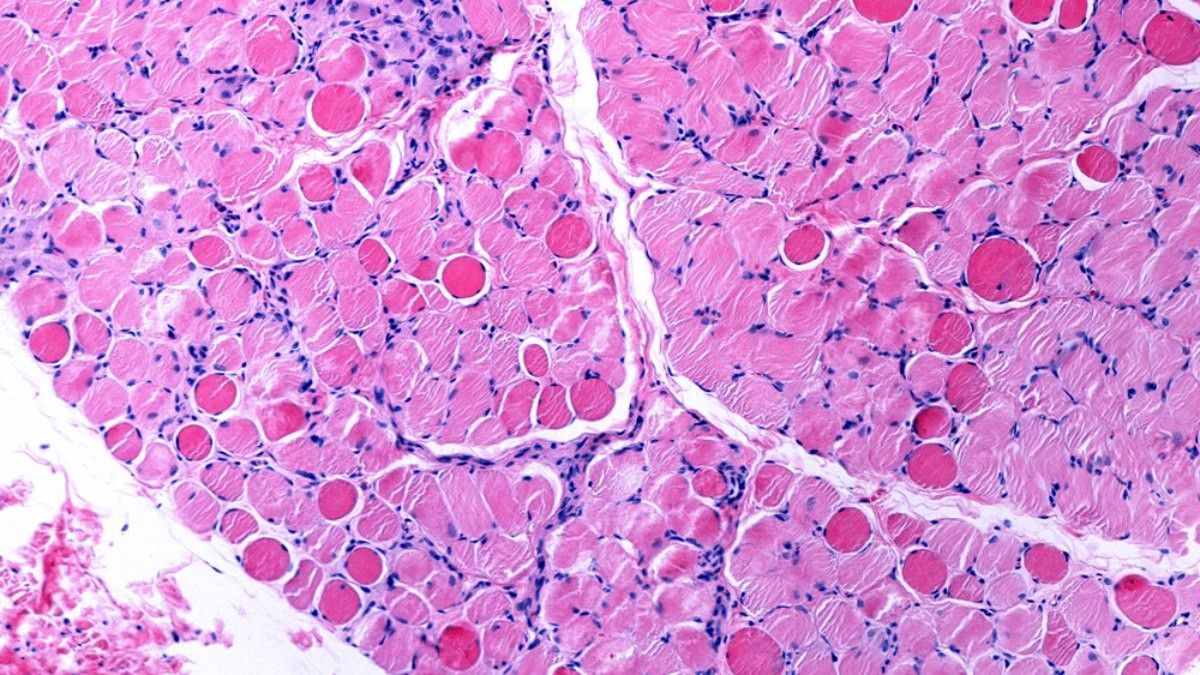 Duchenne Muscular Dystrophy
