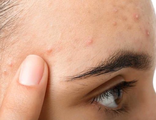 Bau Jerawat dan Hubungannya dengan Kesehatan Kulit