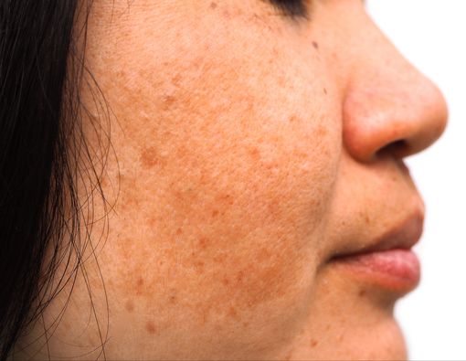 Kenali Gejala Melasma pada Wajah