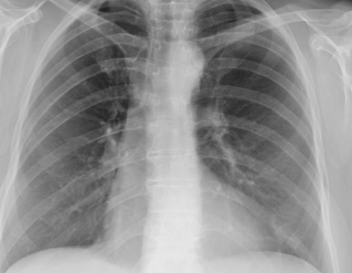 Inilah Cara Membersihkan Paru-paru bagi Perokok Aktif