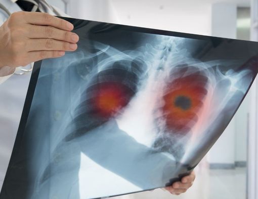 Pantangan Makanan yang Sebaiknya Dihindari Pasien Kanker Paru