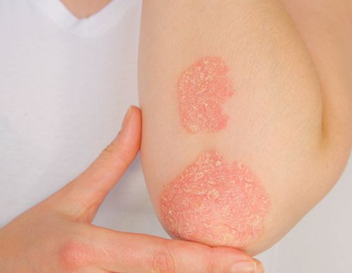 Penyakit Kulit yang Sering Terjadi pada Anak Berkebutuhan Khusus