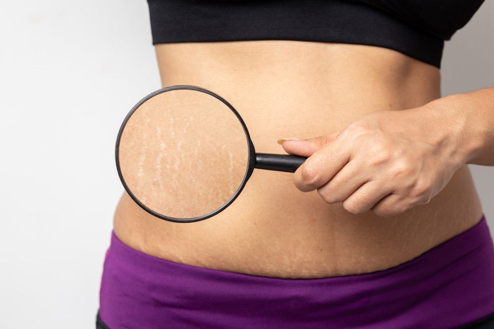 Cegah dan Atasi Stretch Mark dengan Cara Alami Ini