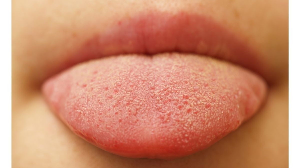 Penyebab dan Gejala Scalloped Tongue, Kondisi Lidah Bergigi