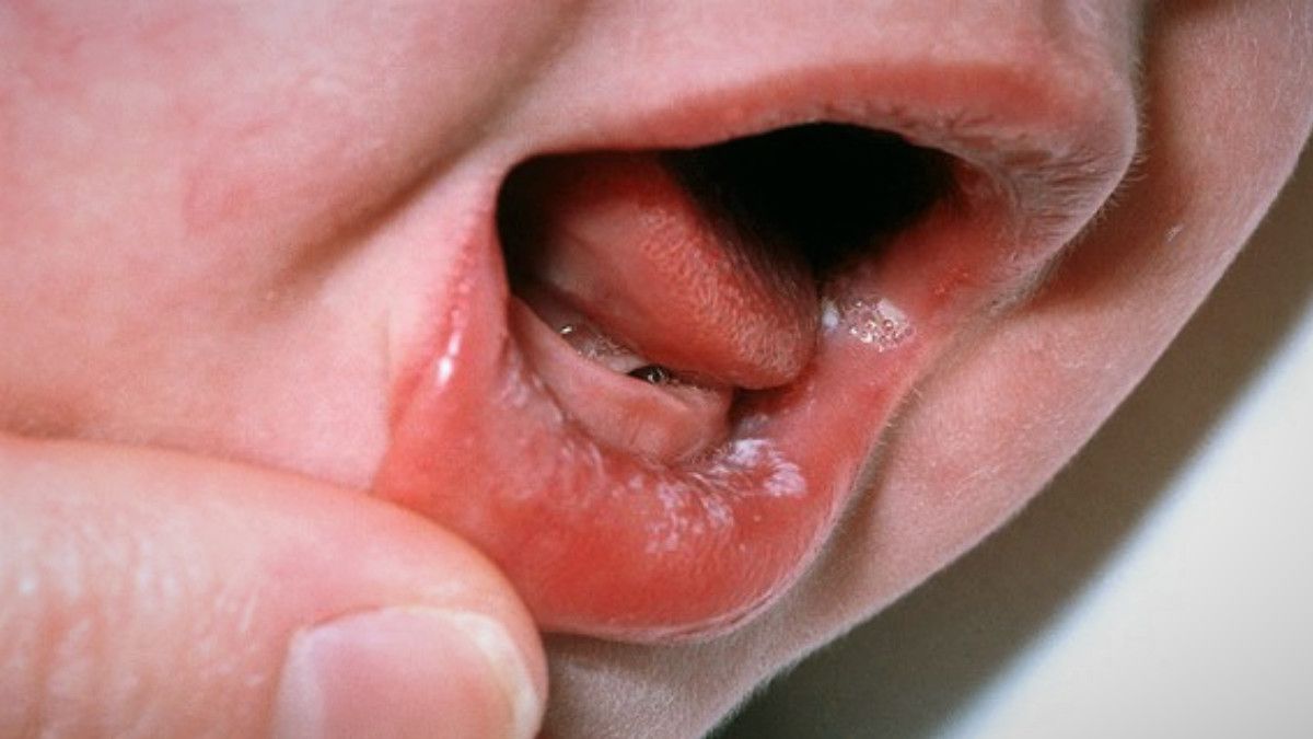 Sariawan pada Bayi Bisa Sembuh dengan ASI, Benarkah? (Foto: Alamy)