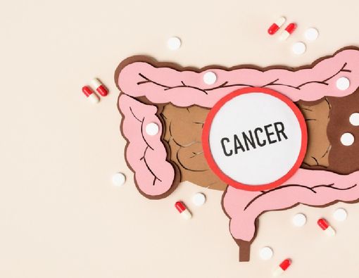 Kanker Usus Besar Bisa Disebabkan Faktor Genetik, Ini Faktanya
