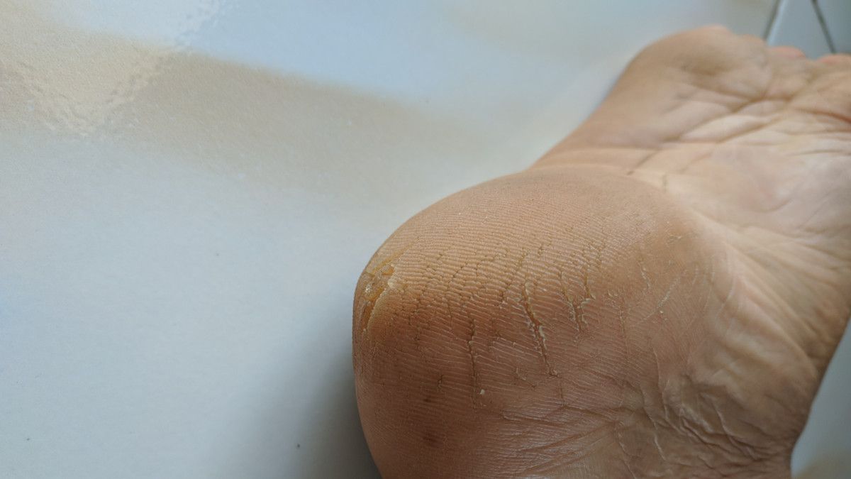 Cara Alami Mengatasi Kaki Pecah-Pecah