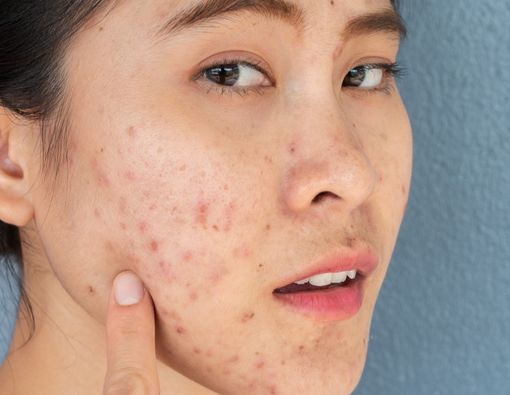 Masalah Kulit yang Sering Dialami Remaja
