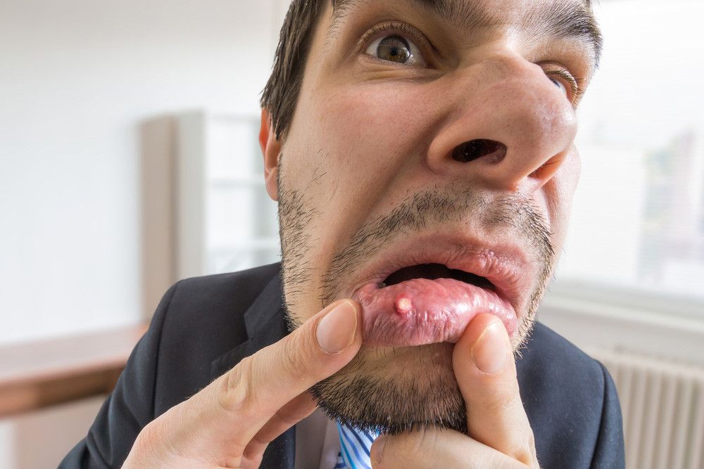 Stomatitis Aphtous Reccurent/SAR (Sariawan)