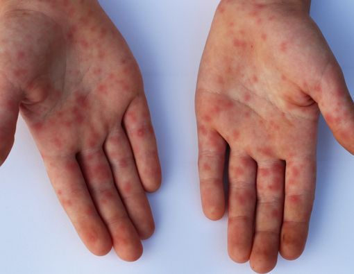 Kenali Flu Singapura dan Cara Pencegahannya