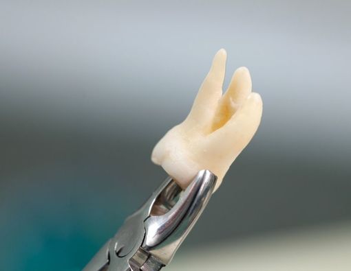 Benarkah Cabut Gigi Atas Pengaruhi Kondisi Mata?