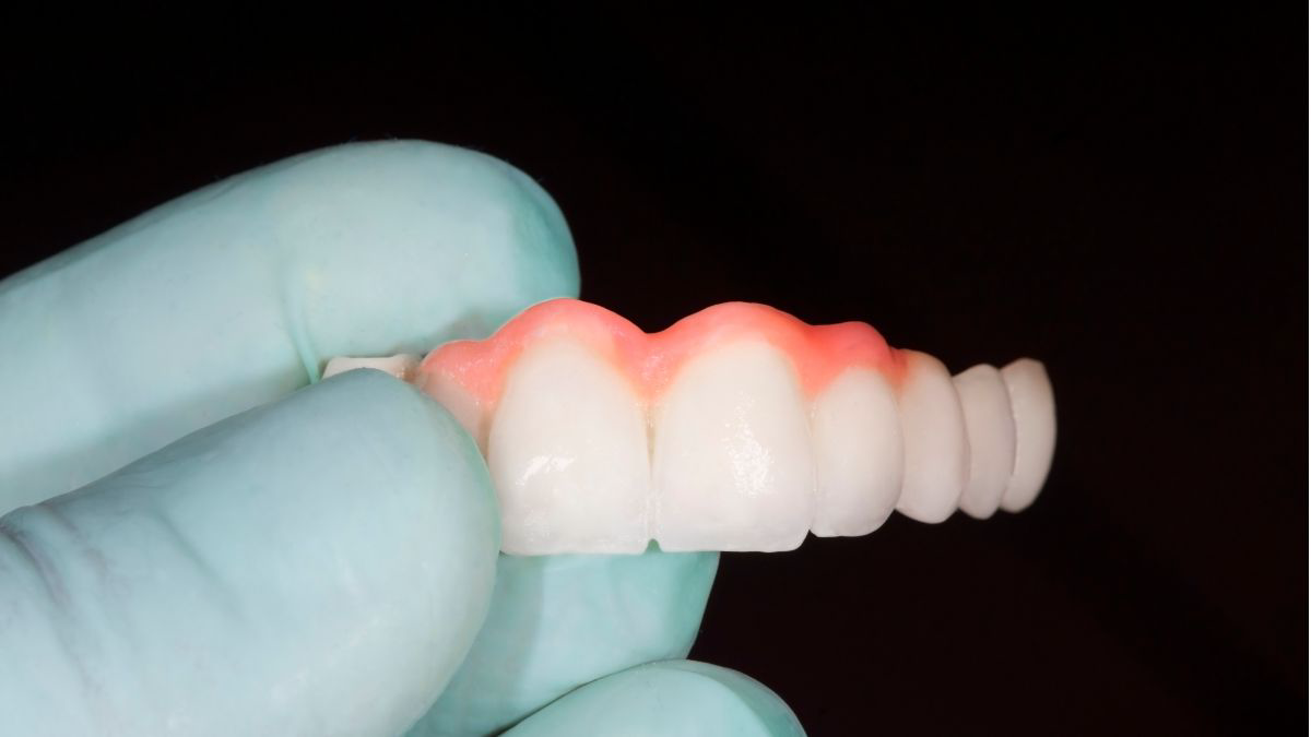 Mengenal Dental Bridge, Gigi Palsu Permanen yang Nyaman Digunakan