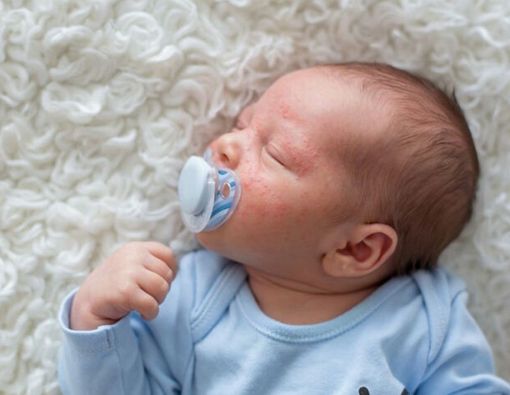 Penyebab dan Pengobatan Dermatitis Atopik pada Anak