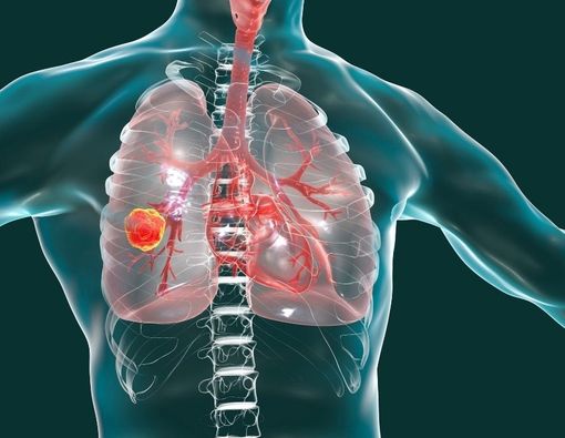 Gejala Kanker Paru Stadium Empat dan Penanganannya