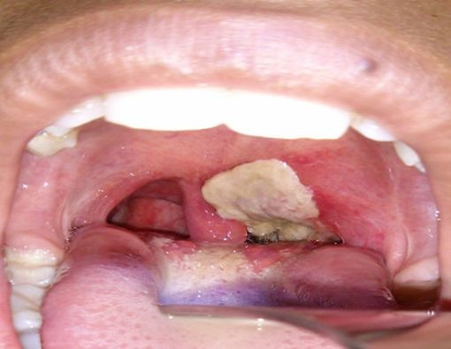 3 Komplikasi Difteri yang Perlu Anda Tahu