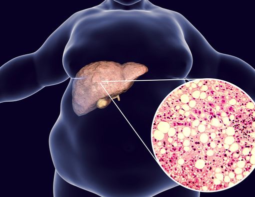 Waspadai 7 Faktor Risiko Fatty Liver Ini