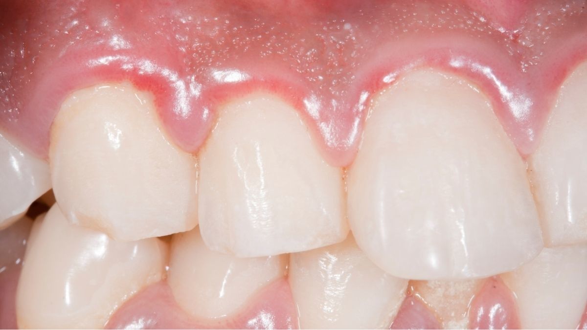Kondisi Ini Pengaruhi Gingival Sulcus, Celah antara Gigi dan Gusi
