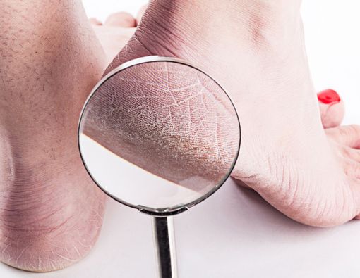 9 Penyebab Kaki Pecah-Pecah dan Cara Mencegahnya