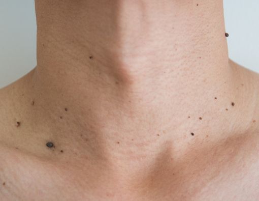 Tindakan Medis yang Aman untuk Hilangkan Kutil pada Ibu Hamil