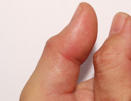 Penyebab Jempol Bengkak dan Cara Mengatasinya