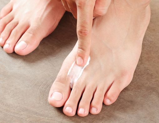 Tips Memilih Obat untuk Atasi Infeksi Jamur Kulit